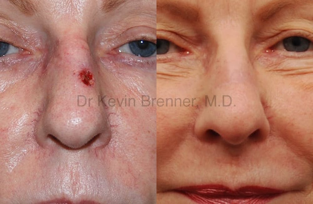 Skin Cancer Reconstruction Before & After Gallery - Patient 1482577 - Image 1
