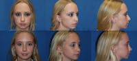 Rhinoplasty Before & After Gallery - Patient 1482578 - Image 1