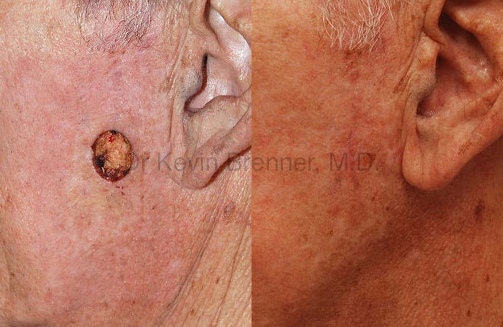 Skin Cancer Reconstruction Before & After Gallery - Patient 1482580 - Image 1