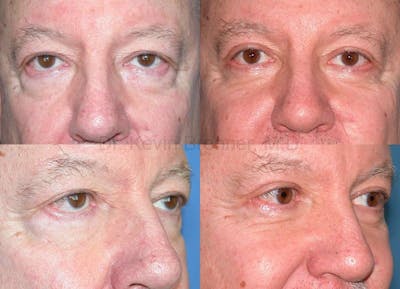 Eyelid Surgery Before & After Gallery - Patient 1482579 - Image 1