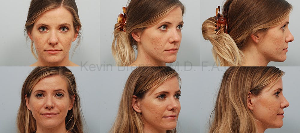 Rhinoplasty Before & After Gallery - Patient 1482581 - Image 1