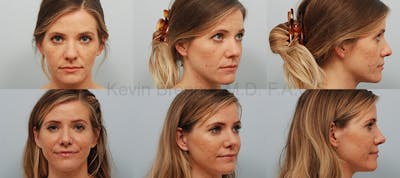 Rhinoplasty Before & After Gallery - Patient 1482581 - Image 1