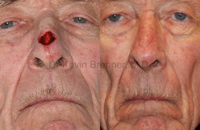 Skin Cancer Reconstruction Before & After Gallery - Patient 1482582 - Image 1