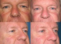 Eyelid Surgery Before & After Gallery - Patient 1482583 - Image 1