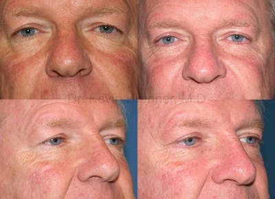 Eyelid Surgery Before & After Gallery - Patient 1482583 - Image 1