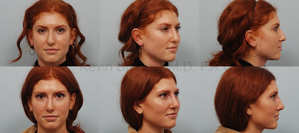 Rhinoplasty Before & After Gallery - Patient 1482584 - Image 1