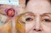 Skin Cancer Reconstruction Before & After Gallery - Patient 1482585 - Image 1