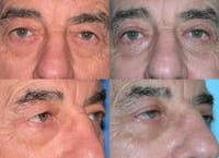 Eyelid Surgery Before & After Gallery - Patient 1482586 - Image 1