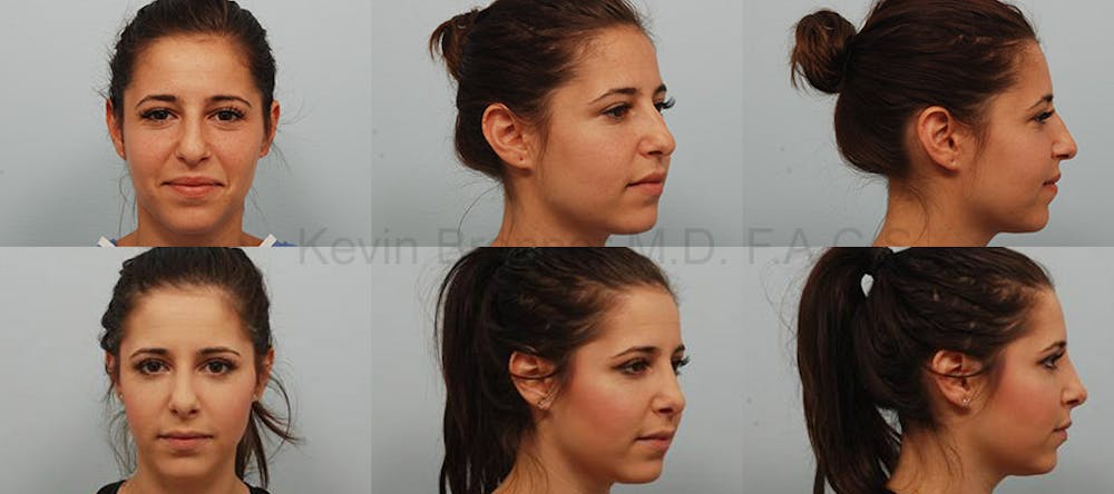 Rhinoplasty Before & After Gallery - Patient 1482587 - Image 1