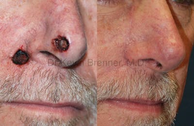 Skin Cancer Reconstruction Before & After Gallery - Patient 1482588 - Image 1