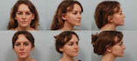 Rhinoplasty Before & After Gallery - Patient 1482589 - Image 1