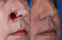 Skin Cancer Reconstruction Before & After Gallery - Patient 1482590 - Image 1