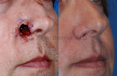 Skin Cancer Reconstruction Before & After Gallery - Patient 1482590 - Image 1