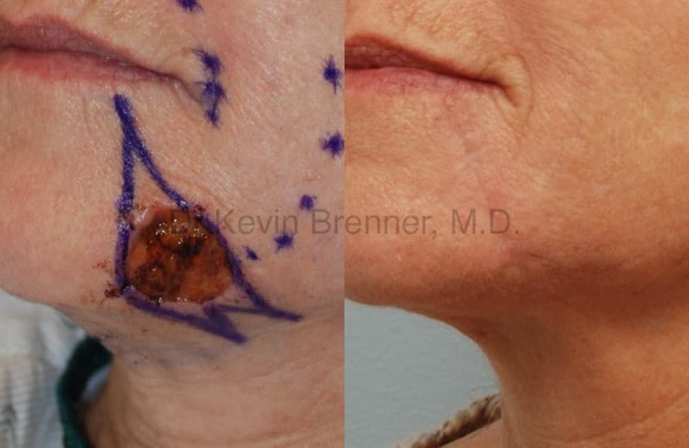 Skin Cancer Reconstruction Gallery - Patient 1482591 - Image 1