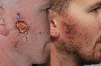 Skin Cancer Reconstruction Before & After Gallery - Patient 1482592 - Image 1