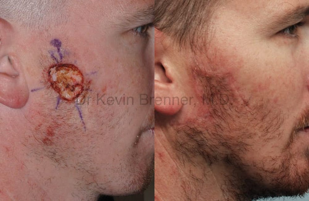Skin Cancer Reconstruction Before & After Gallery - Patient 1482592 - Image 1