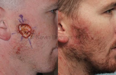 Skin Cancer Reconstruction Gallery - Patient 1482592 - Image 1