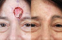 Skin Cancer Reconstruction Before & After Gallery - Patient 1482593 - Image 1