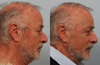 Skin Cancer Reconstruction Gallery - Patient 1482596 - Image 1