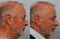 Skin Cancer Reconstruction Before & After Gallery - Patient 1482596 - Image 1