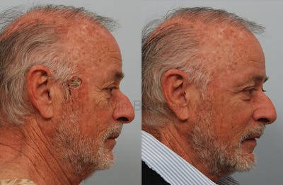 Skin Cancer Reconstruction Before & After Gallery - Patient 1482596 - Image 1