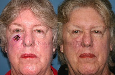 Skin Cancer Reconstruction Before & After Gallery - Patient 1482597 - Image 1