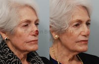 Skin Cancer Reconstruction Before & After Gallery - Patient 1482598 - Image 1