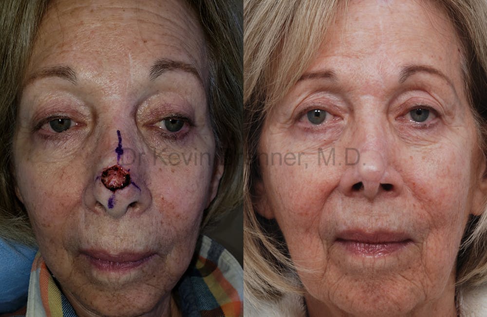 Skin Cancer Reconstruction Gallery - Patient 1482599 - Image 1