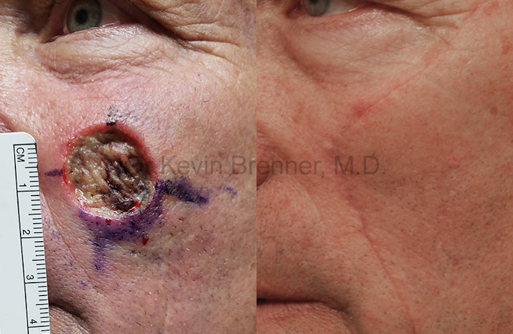 Skin Cancer Reconstruction Before & After Gallery - Patient 1482600 - Image 1