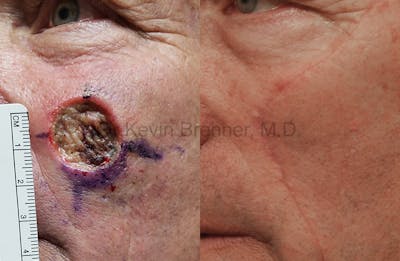 Skin Cancer Reconstruction Before & After Gallery - Patient 1482600 - Image 1