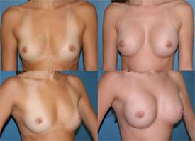 Breast augmentation before and after 7