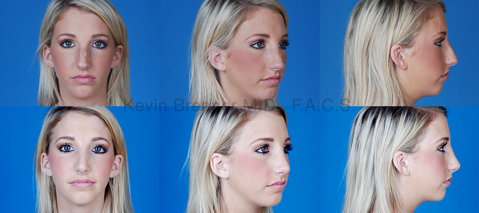 Before and after of Nose Surgery in Beverly Hills