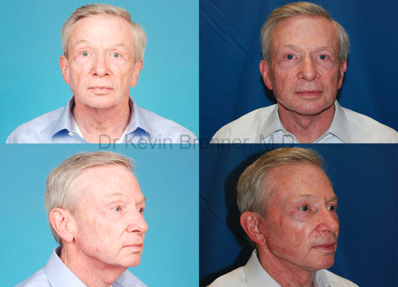 photo of facial resurfacing patient