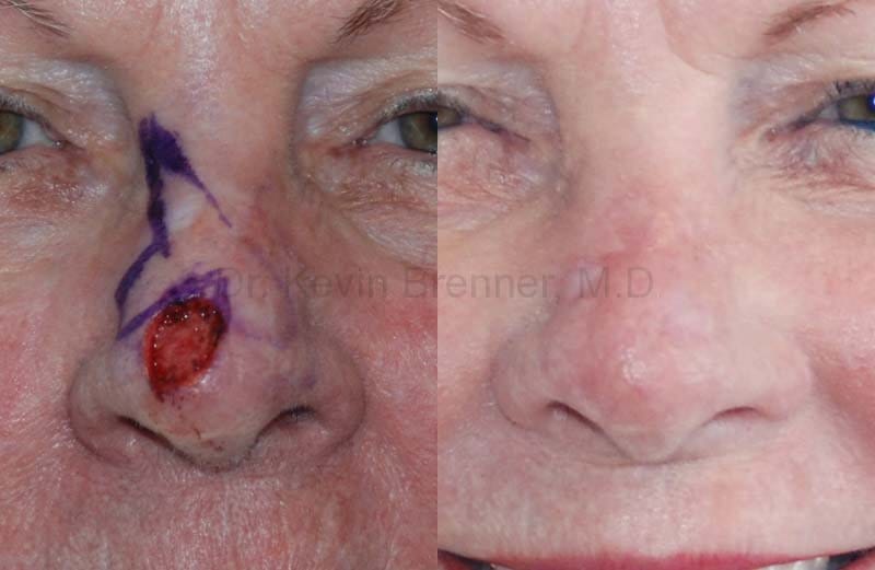 before and after of faical skin reconstsructions