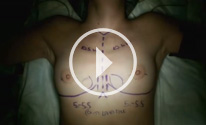 Breast Augmentation video