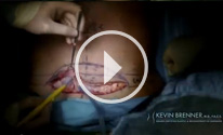 Mini tummy tuck video