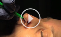 Nasal Ala Reconstruction video