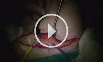 Standard Tummy Tuck video