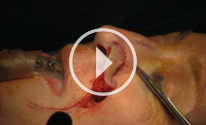 Nasal Ala Reconstruction, Stage II, video