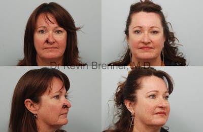 Skin Cancer Reconstruction Before & After Gallery - Patient 1482594 - Image 1