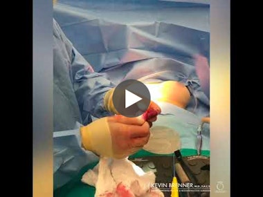 Breast Implant Removal surgical video part 2