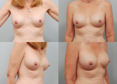 Breast Augmentation Before & After Gallery - Patient 1533510 - Image 1