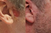 Skin Cancer Reconstruction Before & After Gallery - Patient 1533663 - Image 1