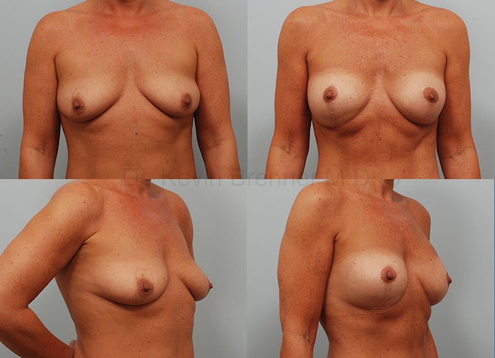 Breast Augmentation Before & After Gallery - Patient 1482318 - Image 1