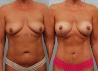 Mommy Makeover Before & After Gallery - Patient 1568349 - Image 1
