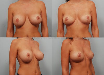 Breast Lift Before & After Gallery - Patient 305526 - Image 1