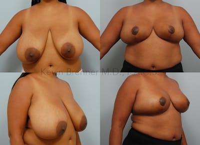 Breast Reduction Before & After Gallery - Patient 10131093 - Image 1
