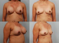 Breast Implant Removal without Lift Before & After Gallery - Patient 339618 - Image 1