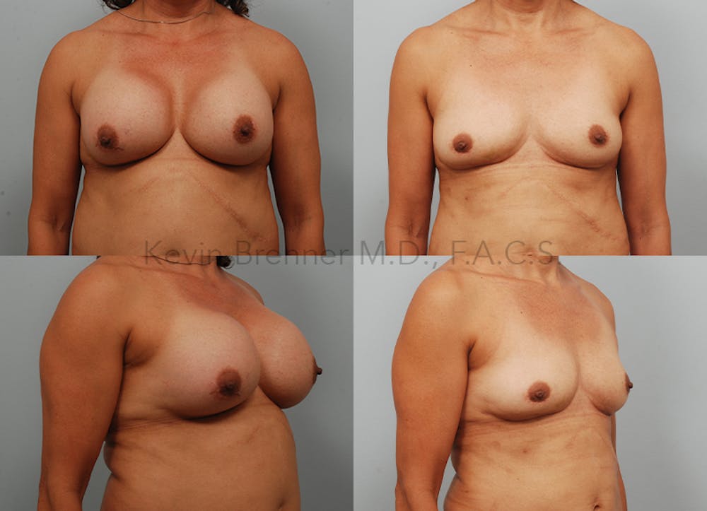 Breast Implant Removal without Lift Before & After Gallery - Patient 339618 - Image 1