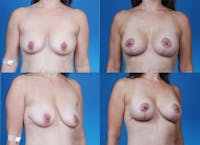 Breast Lift with Augmentation Before & After Gallery - Patient 10131258 - Image 1